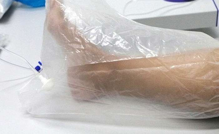 اوزون تراپی زخم دیابتی، سوختگی، بستر و ... | کلینیک زخم ایرانیان