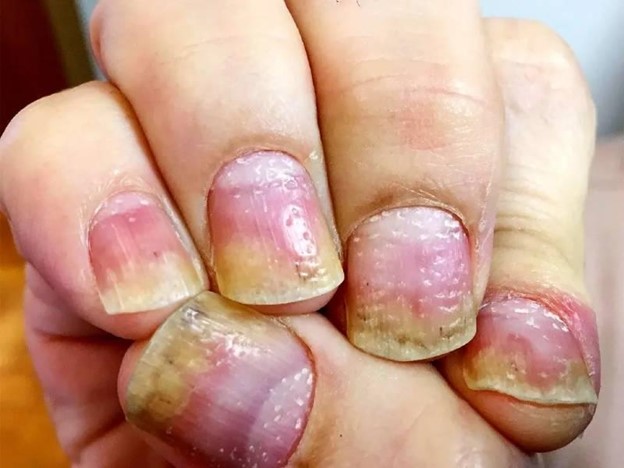 آیا پسوریازیس ناخن درمان قطعی دارد؟